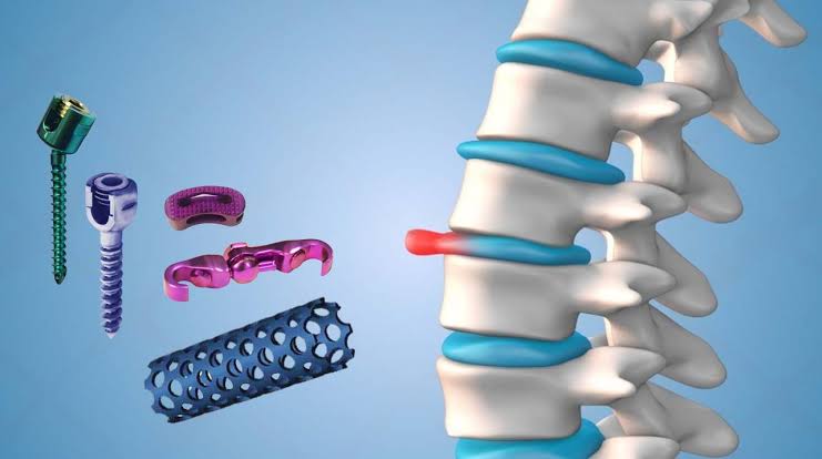 Spinal implant hardware - pedicle screws, interbody cage, rod